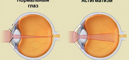 Астигматизм: виды и коррекция