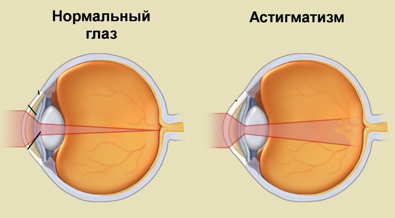 Астигматизм: виды и коррекция